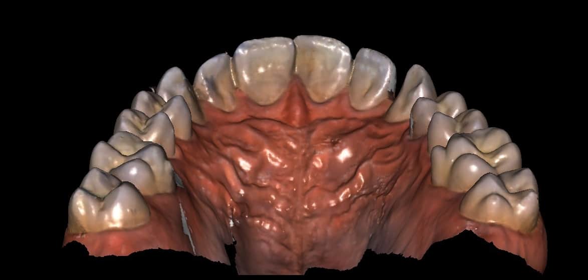 imagem computadorizada de uma arcada dentária exemplificando a odontologia digital