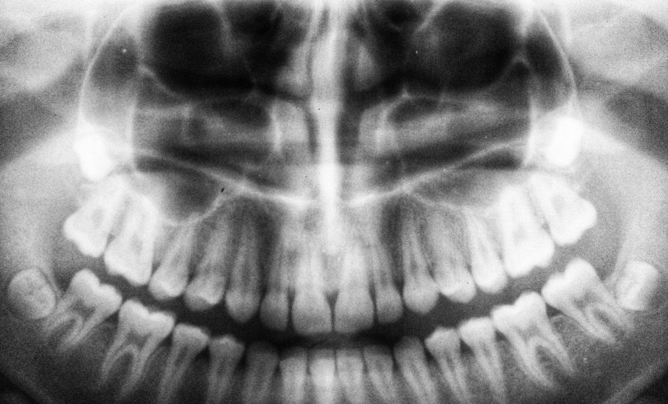 close de um raio-X de uma arcada dentária