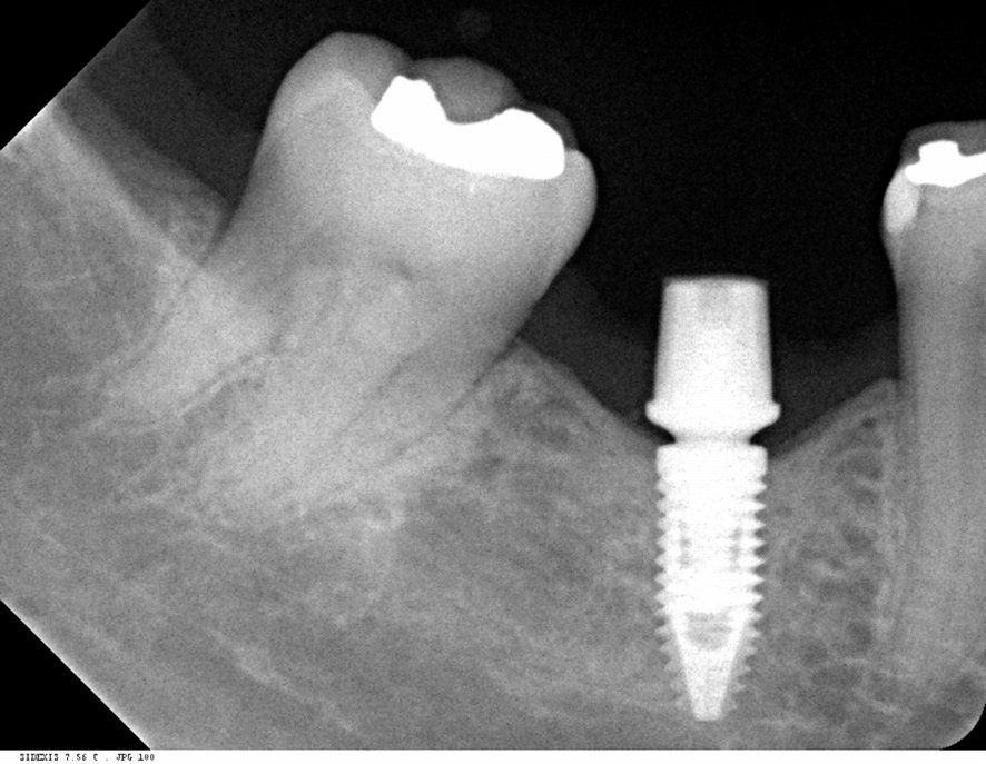 radiografia periapical de um implante