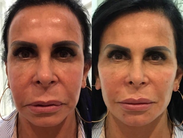 harmonização orofacial