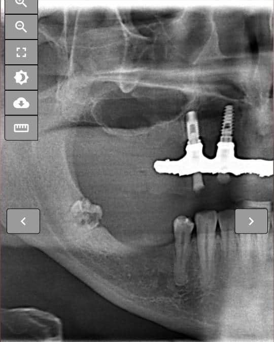 tomografia pré implante - Osteomielite Mandibular