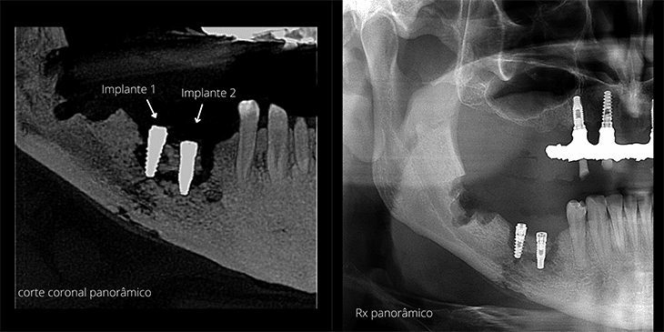 panoramica-pos-implante-Osteomielite