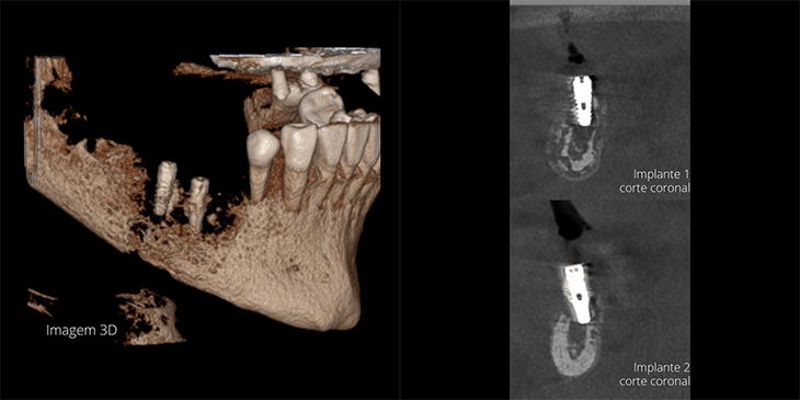 tomografia-pos-implante-Osteomielite