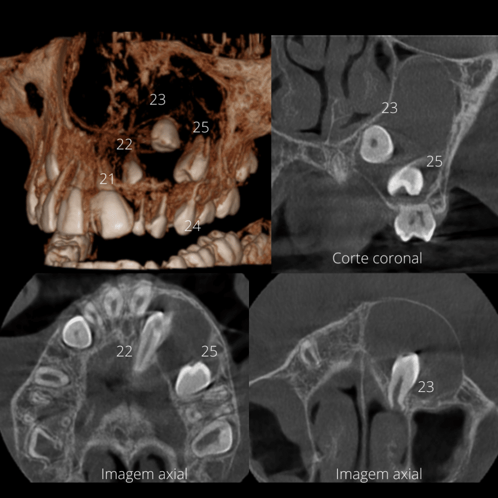 Tumor odontogênico adenomatoide 