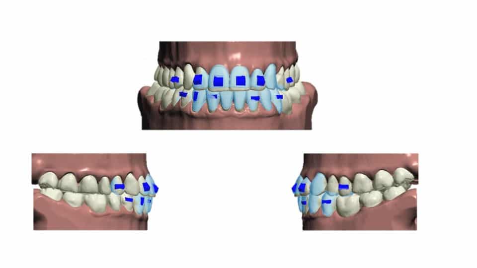 setup ortodôntico virtual