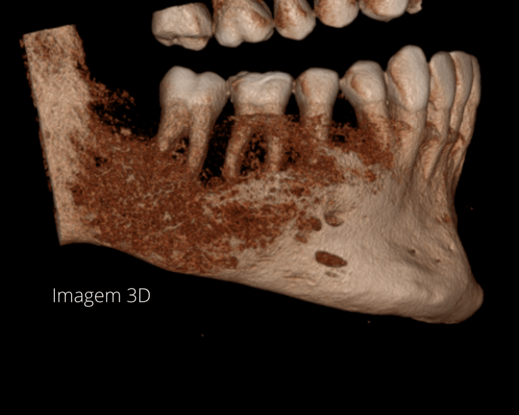 displasia fibrosa monostótica