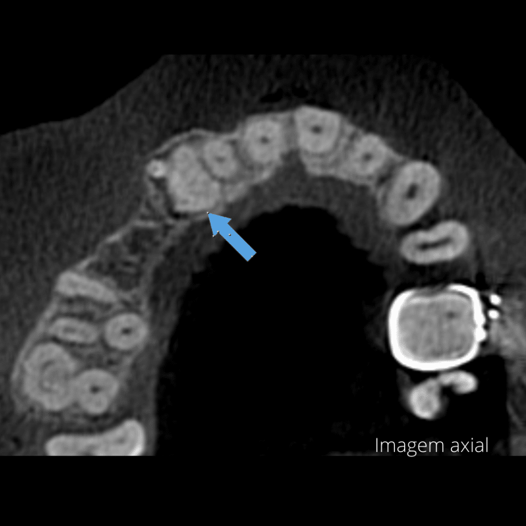 Odontomas Compostos X Odontomas Complexos - DVI Radiologia agora é DVI ...