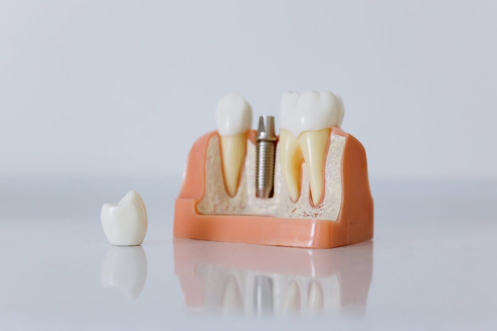 impressão 3d na odontologia