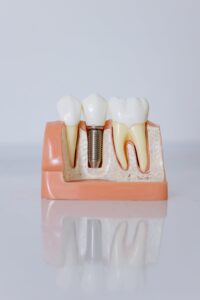 como é feito um implante de dente