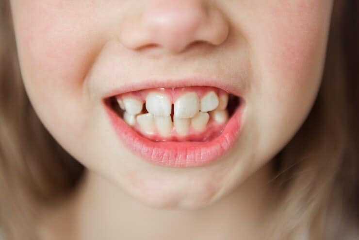 anomalia do tamanho e da forma dos dentes