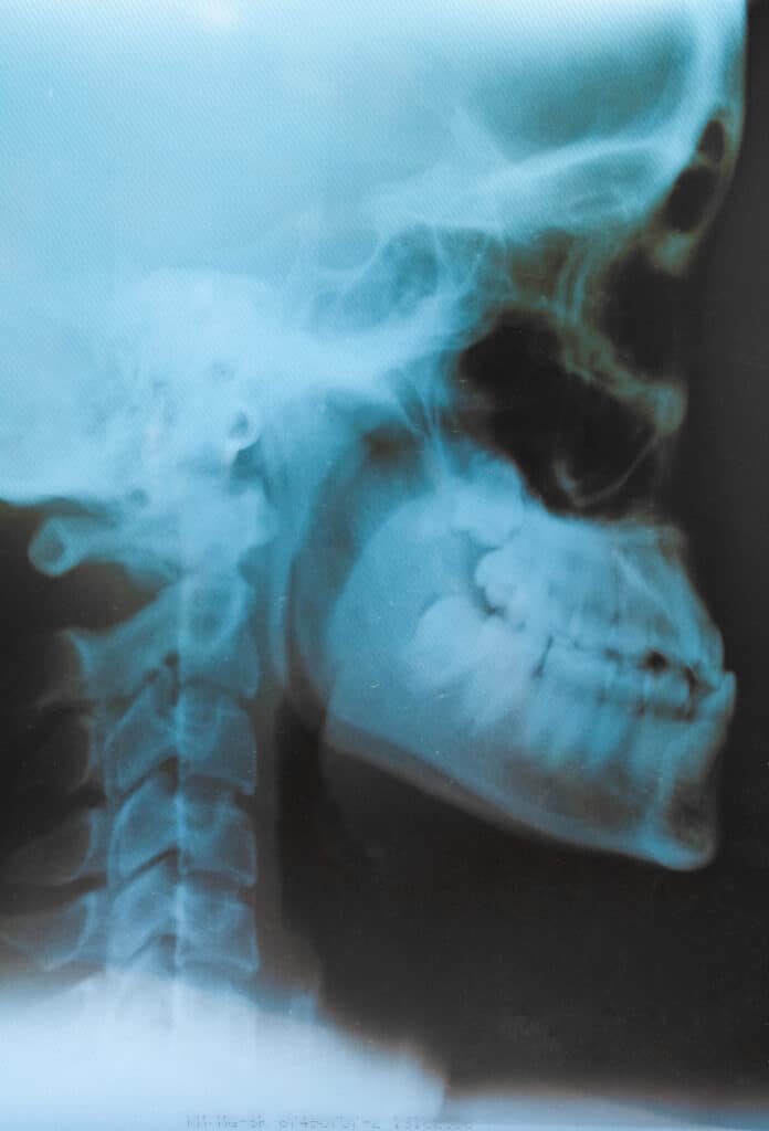 radiografia de cavum