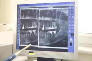 o que é radiografia periapical