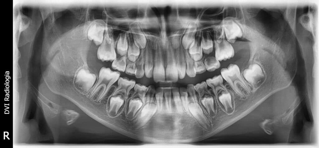 dentes decíduos