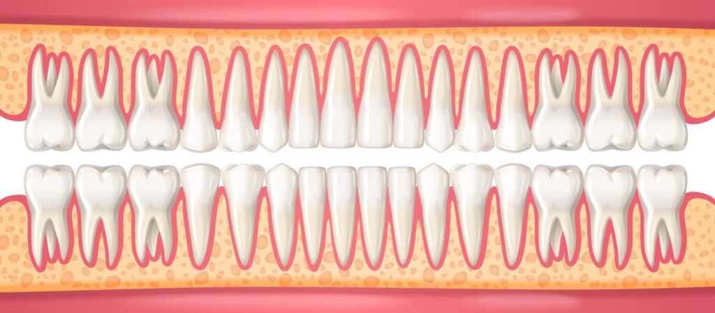 reabsorção da raiz do dente
